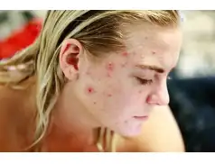 Czym jest trądzik różowaty? 