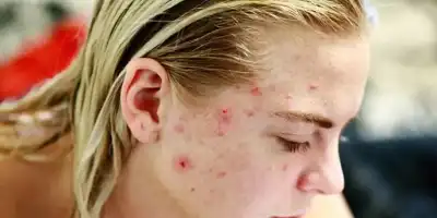 Czym jest trądzik różowaty? 