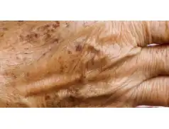 Jak pozbyć się starczych plam na twarzy i ciele?