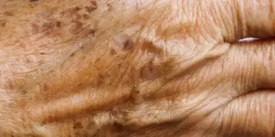 Jak pozbyć się starczych plam na twarzy i ciele?