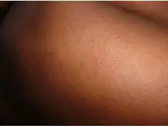 Odra – choroba, która powraca. czym jest i jak się nią nie zakazić?