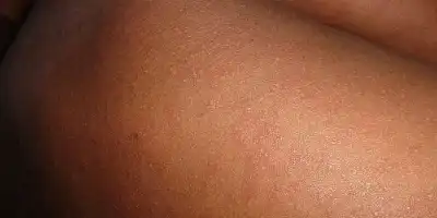 Odra – choroba, która powraca. czym jest i jak się nią nie zakazić?